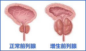 前列腺增生症状,前列腺增生用药,前列腺增生治疗,前列腺增生危害